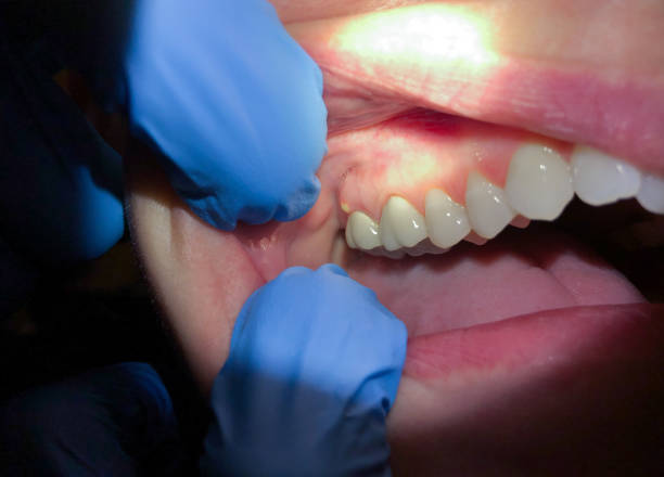 Best Chipped Tooth Repair Near Me  in Wahoo, NE